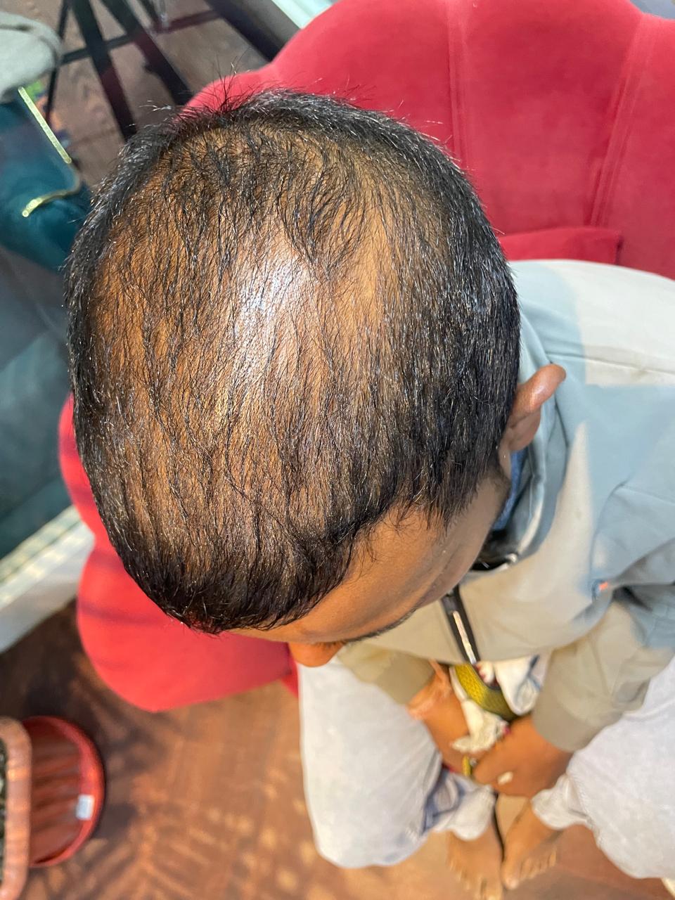 Before - Hyper Hydra + PRP